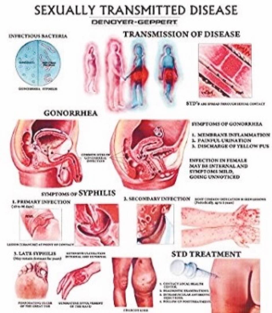 STDs Symptoms causes And Prevention