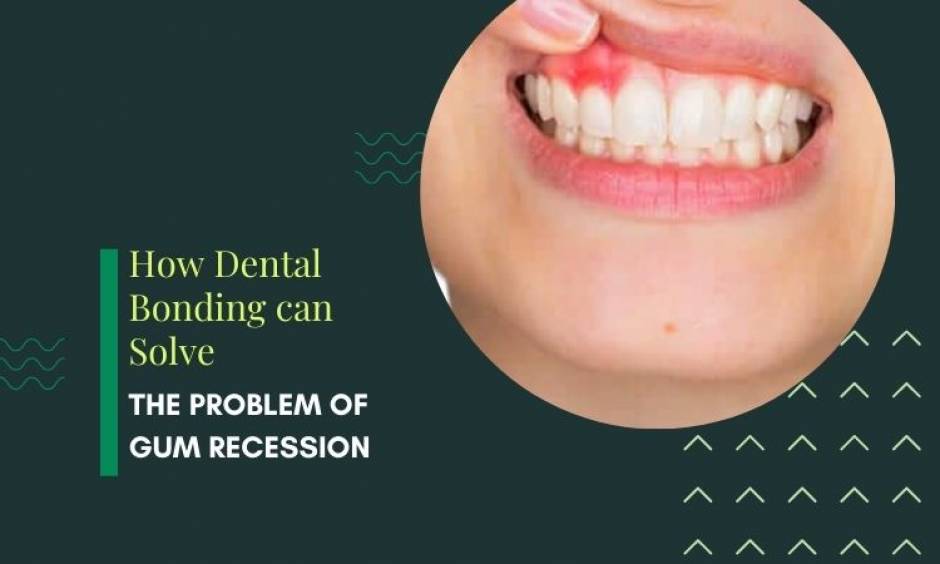 How Dental Bonding can Solve the Problem of Gum Recession