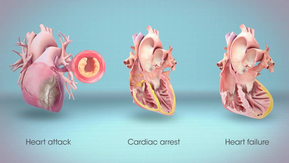 Know the difference between heart attack and heart failure