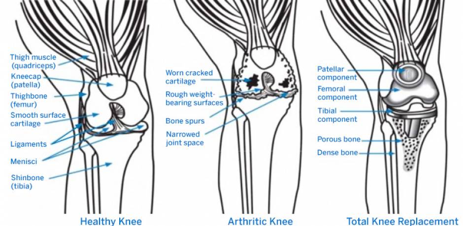 Types Of Knee Replacement Implants