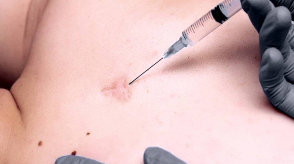 Keloid treatment near me