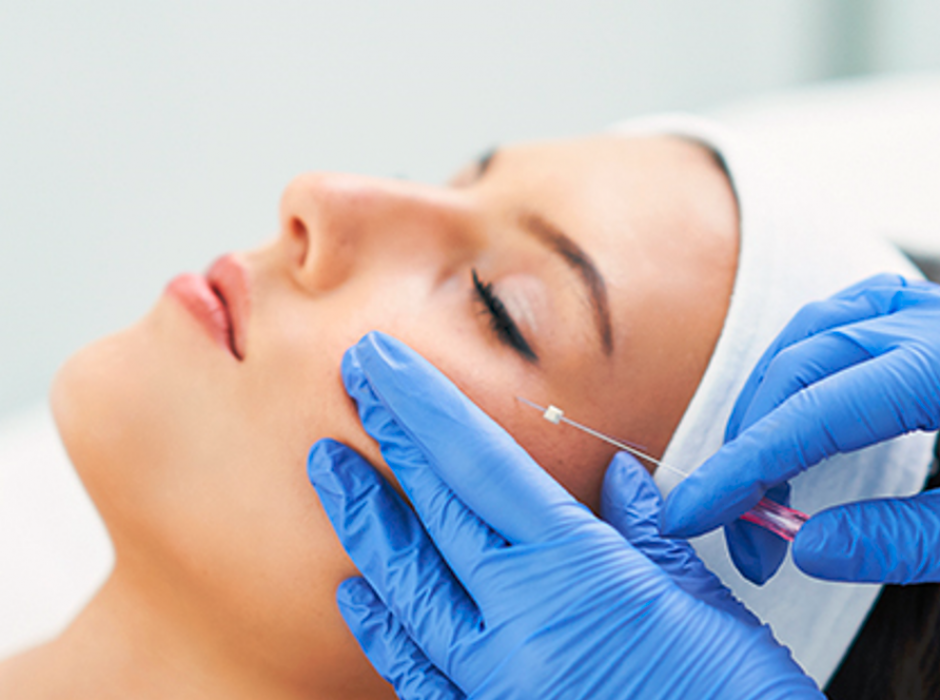 Lifted Elegance The Thread Lift Revolution Unveiled